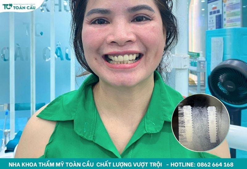 Mất răng lâu năm có trồng được không và chi phí bao nhiêu? 3 Trồng răng implant