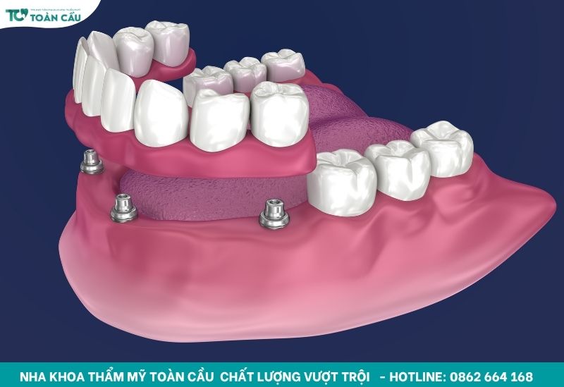 Mất răng lâu năm có trồng được không và chi phí bao nhiêu? 4 Phương pháp làm cầu răng sứ