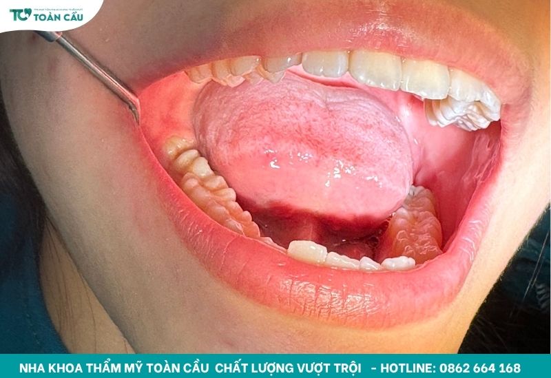 Vì sao nhổ răng khôn lại bị sưng mặt?