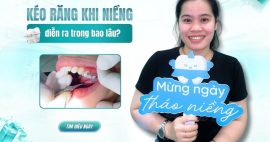 Quá trình kéo răng khi niềng diễn ra bao lâu thì hoàn tất?