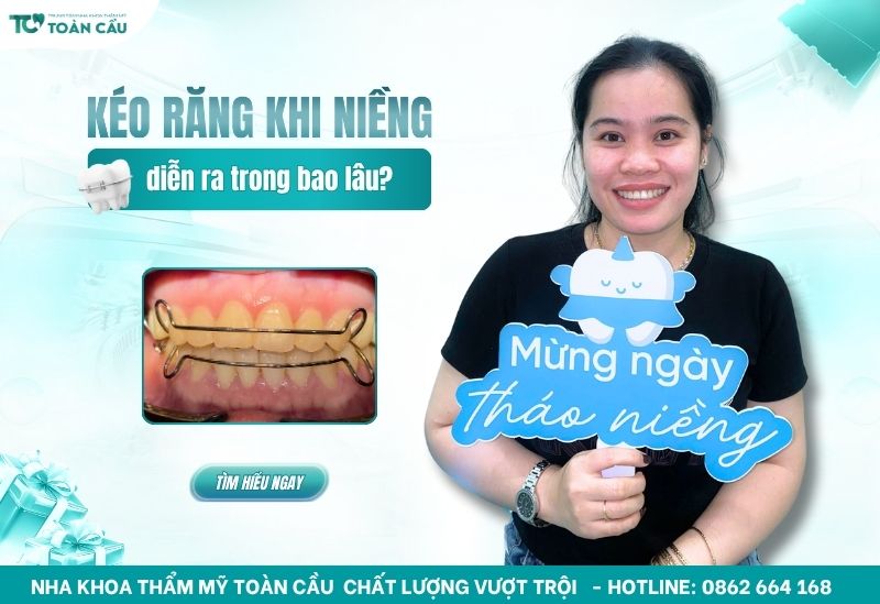 Quá trình kéo răng khi niềng diễn ra bao lâu thì hoàn tất? 1 Quá trình kéo răng khi niềng diễn ra bao lâu thì hoàn tất?