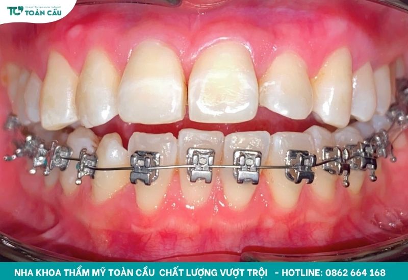 Quá trình kéo răng khi niềng diễn ra bao lâu thì hoàn tất? 3 Thời gian kéo răng chịu ảnh hưởng bởi nhiều yếu tố