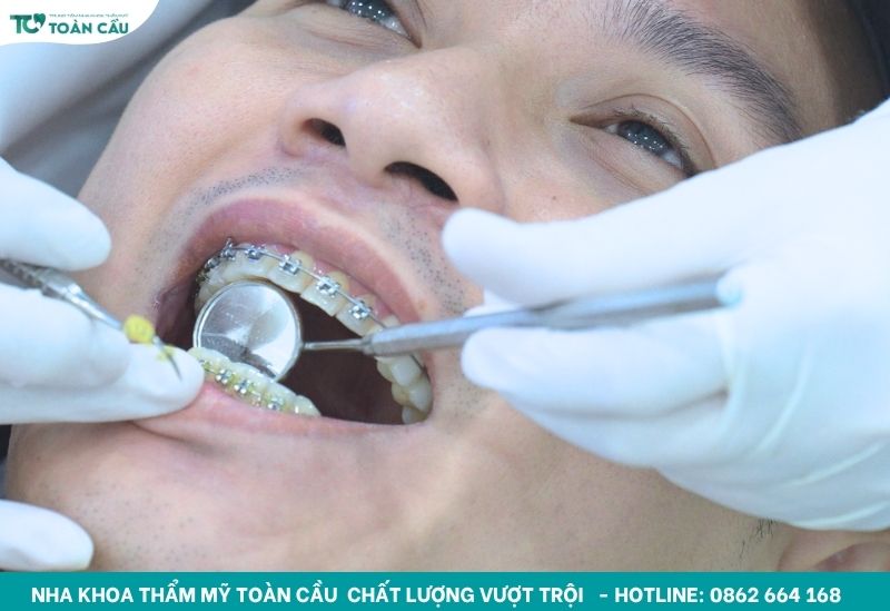 Cảm giác khi niềng răng bình thường sẽ ít đau hơn