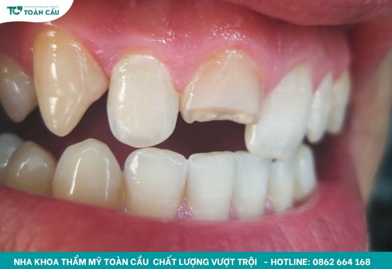 Răng cửa bị mẻ có trám lại được không?