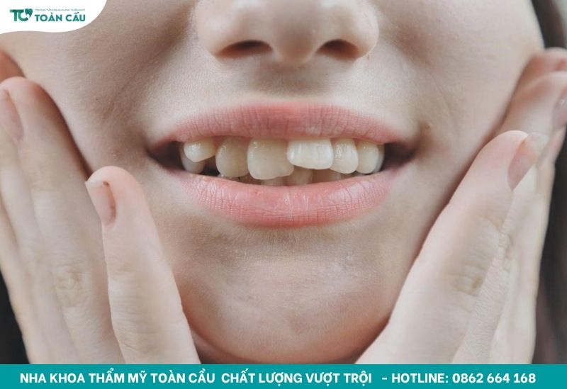 Răng cửa mọc lệch 
