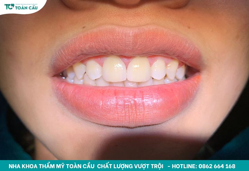 Khách hàng dán sứ Veneer