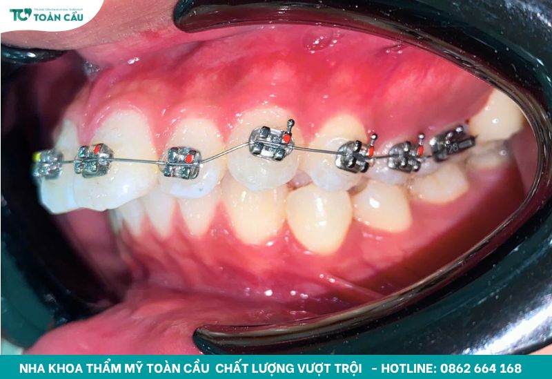 Niềng răng luôn là lựa chọn hàng đầu