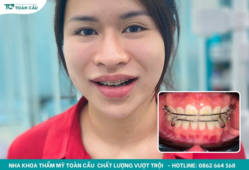 Đeo hàm duy trì sau niềng răng