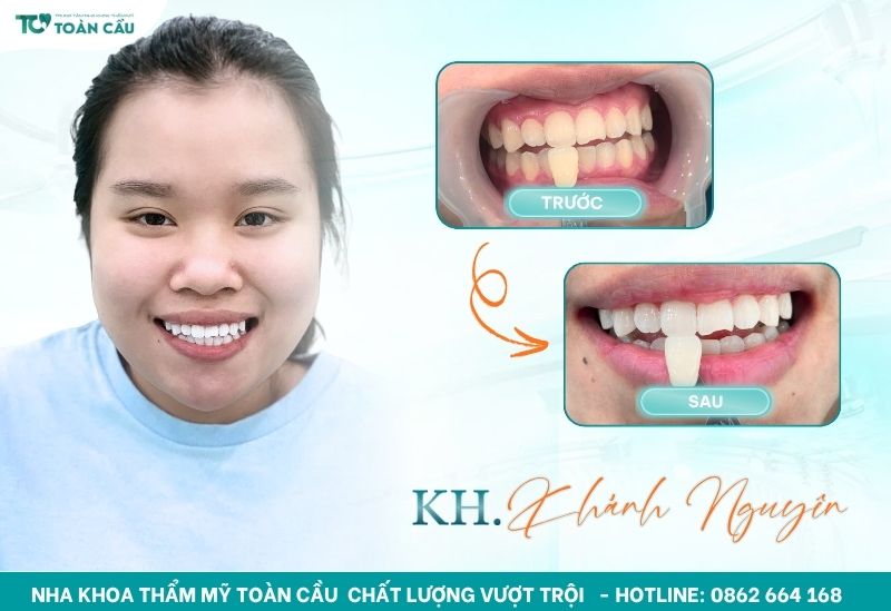 Tẩy răng ố vàng giá bao nhiêu? Có đắt không? 7 Khách hàng tẩy trắng răng