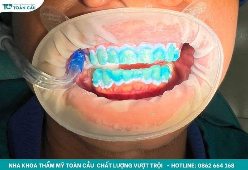 Lo lắng tẩy trắng răng có đau không? Tìm hiểu ngay! 2 Tẩy trắng răng