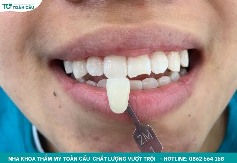 Lo lắng tẩy trắng răng có đau không? Tìm hiểu ngay! 4 Kết quả sau khi tẩy trắng