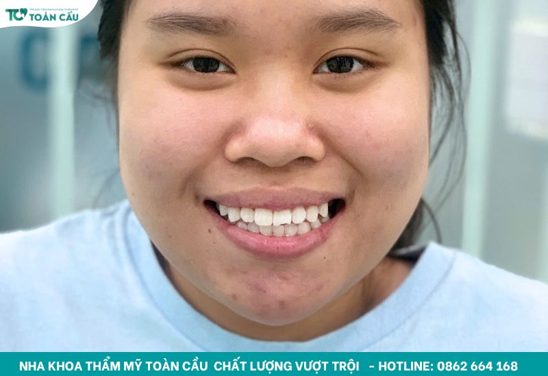 Lo lắng tẩy trắng răng có đau không? Tìm hiểu ngay! 7 Nha khoa tẩy trắng răng