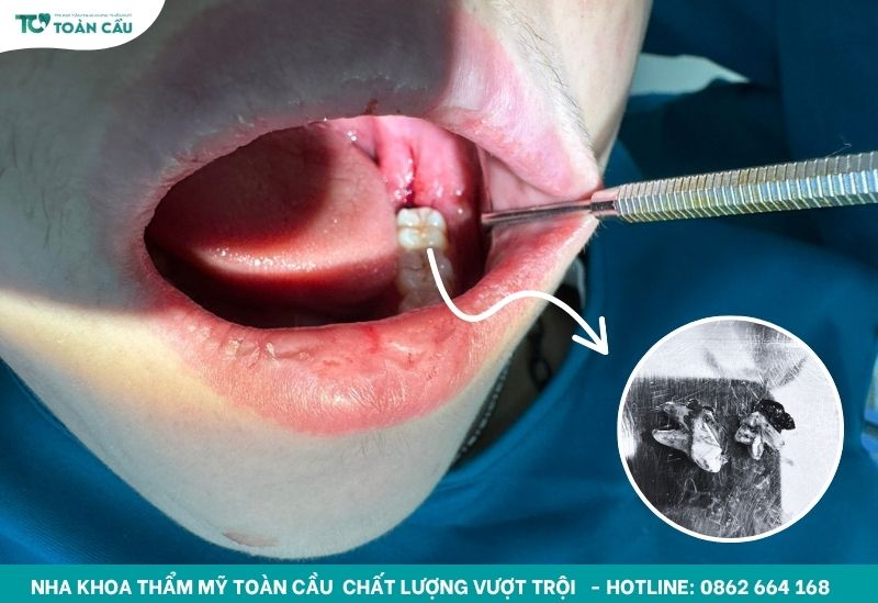 Nhổ răng an toàn tại Toàn Cầu