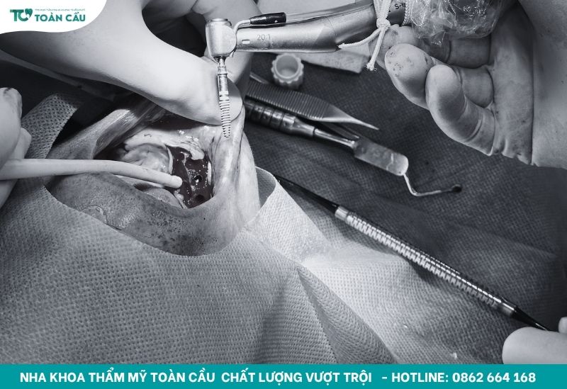 Hình ảnh vừa trồng răng implant