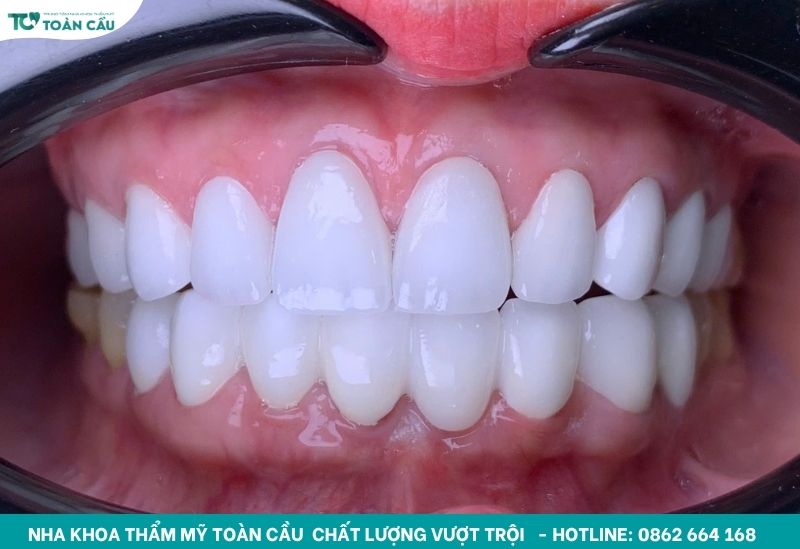 Bọc sứ răng cửa có tốt không?