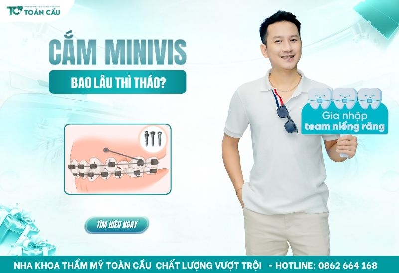 cắm minivis bao lâu thì tháo