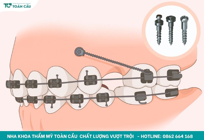 Cắm minivis là đặt một vít titanium nhỏ vào xương hàm