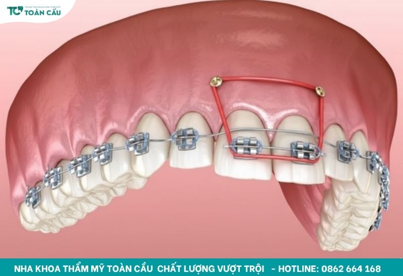 Minivis sẽ được giữ từ 6-12 tháng