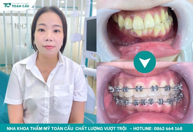 Răng đã di chuyển đến vị trí mong muốn