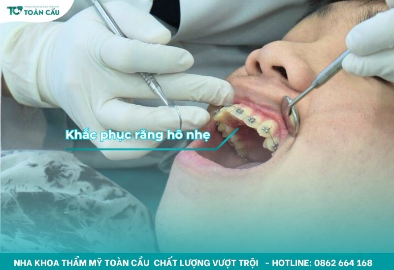 Những ca đơn giản không cần dùng minivis