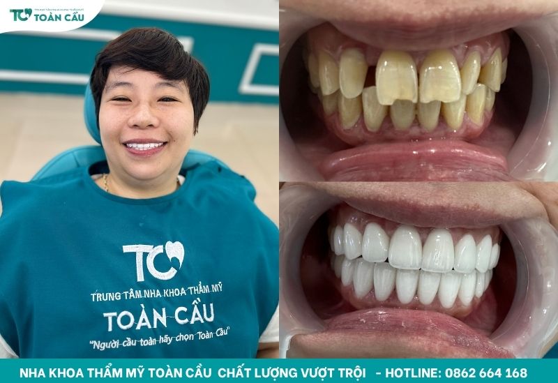 Dáng răng Oval mềm mại