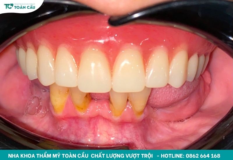 Mất răng gây tiêu xương hàm