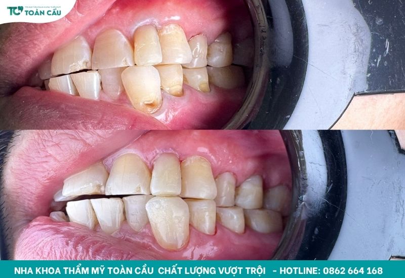 Trám răng với lỗ sâu nhẹ