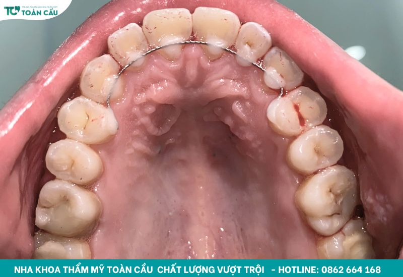 Đeo hàm duy trì cố định