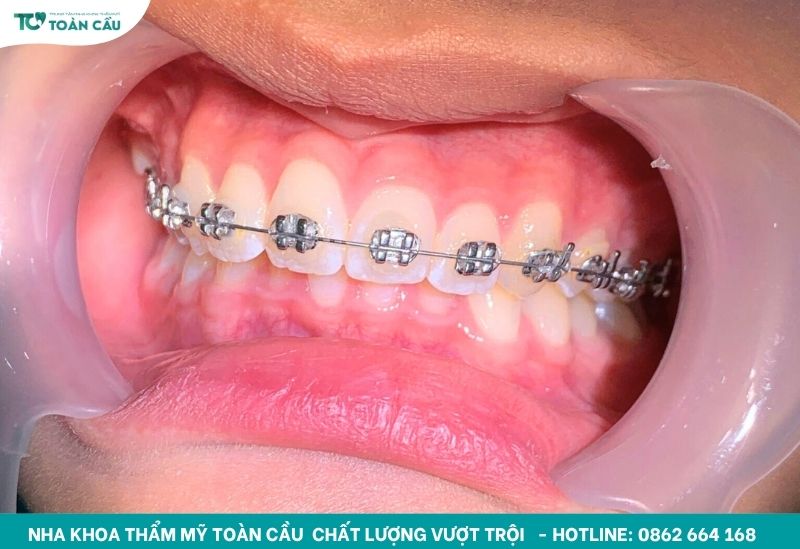 6 địa chỉ niềng răng đẹp TPHCM giá hợp lý, hiệu quả cao 4 Niềng răng mắc cài kim loại là phương pháp phổ biến