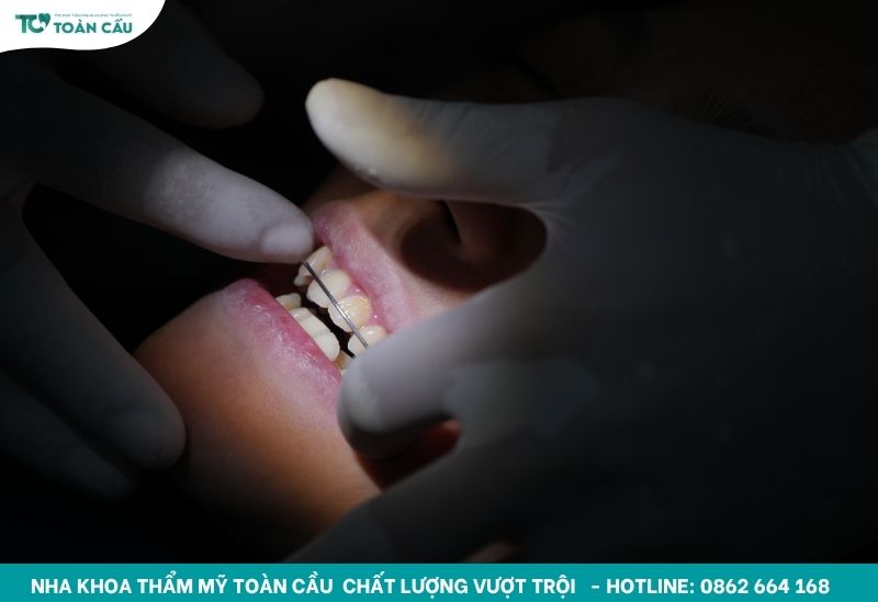 6 địa chỉ niềng răng đẹp TPHCM giá hợp lý, hiệu quả cao 7 Đeo hàm duy trì sau khi niềng