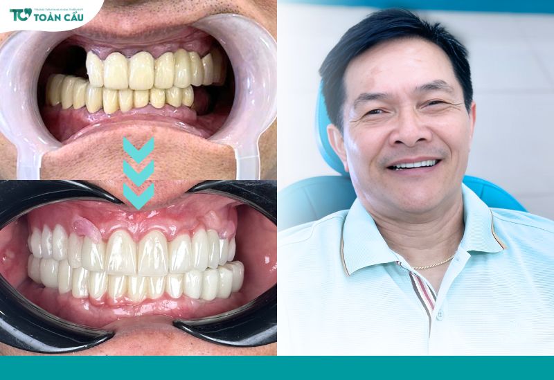 Khách hàng phục hình cấy Implant