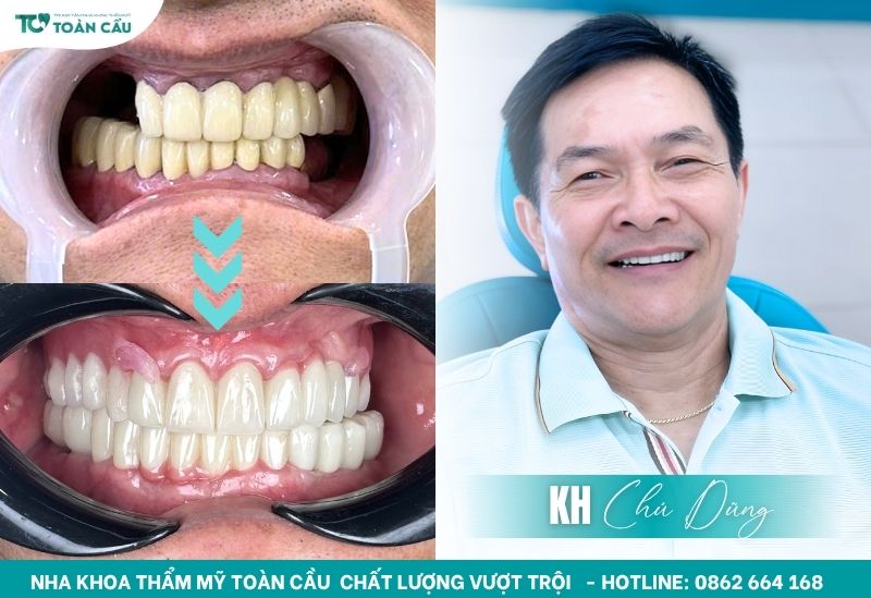Khách hàng cấy ghép implant tại Toàn Cầu