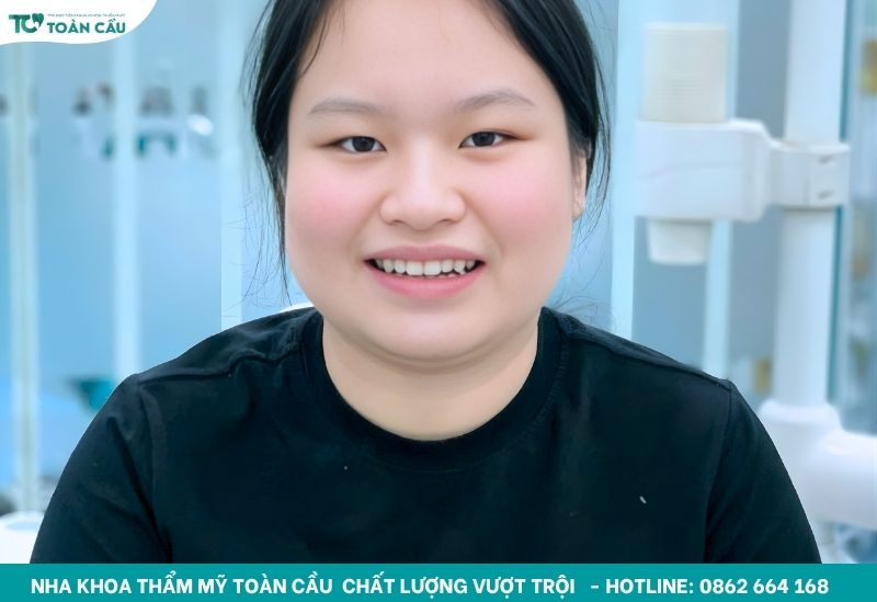 Kết quả niềng răng sau 1 tháng có thay đổi rõ không? 7 Nha khoa Toàn Cầu - Nha khoa niềng răng chuyên nghiệp