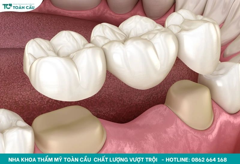 Làm cầu răng sứ