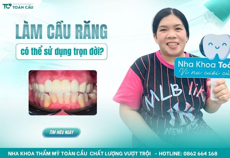 làm cầu răng mất bao lâu