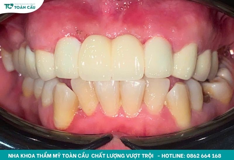 Gắn cố định cầu răng sứ