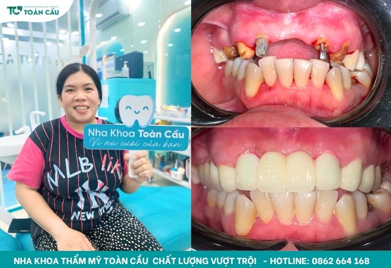 Khách hàng làm cầu răng sứ tại Toàn Cầu