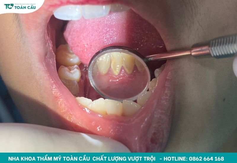 Cao răng tích tụ lâu ngày
