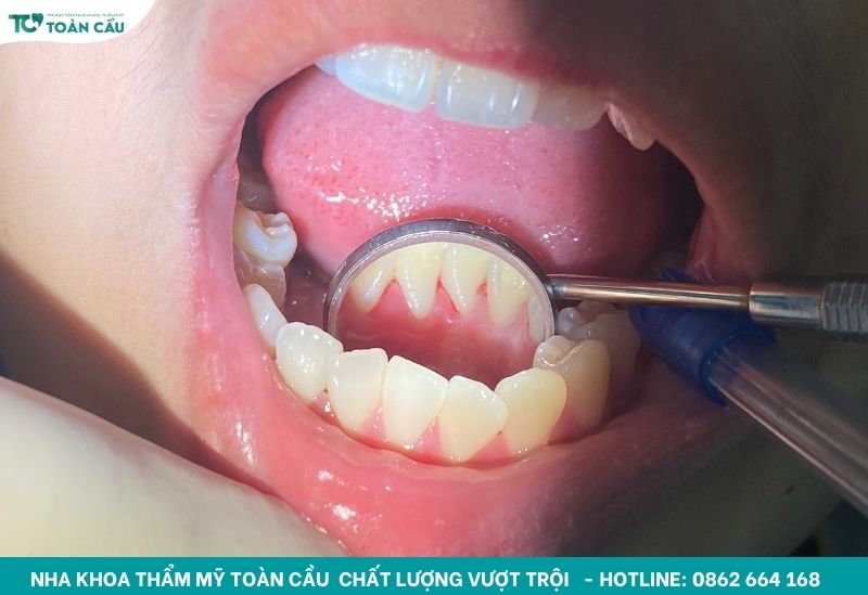 Lấy cao răng không chỉ là thủ thuật thẩm mỹ đơn thuần