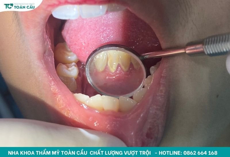 Sau khi cạo vôi răng bao lâu mới được ăn uống?