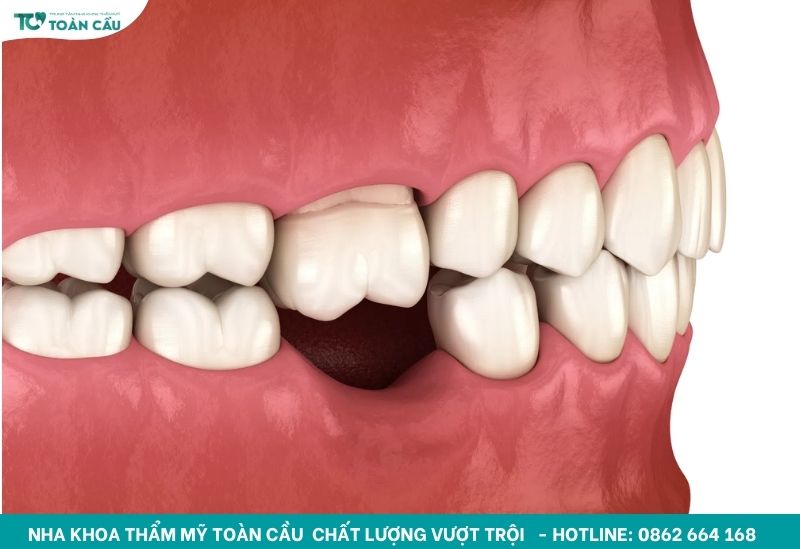 Mất răng hàm có bị lệch mặt không?