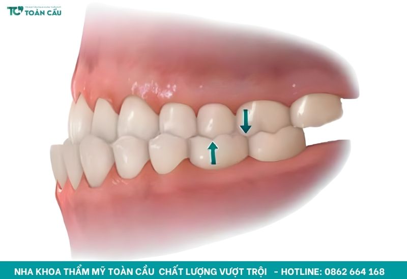 Sai lệch khớp cắn