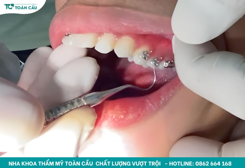 Giải đáp mất răng lâu năm có niềng được không 2 Niềng răng vẫn có thể thực hiện được