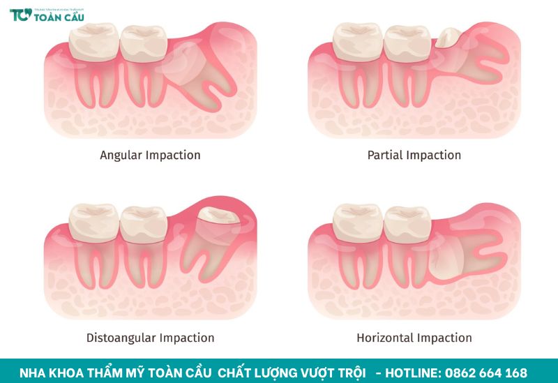 Giải đáp mất răng lâu năm có niềng được không 3 Răng kế cận có thể đã đổ nghiêng