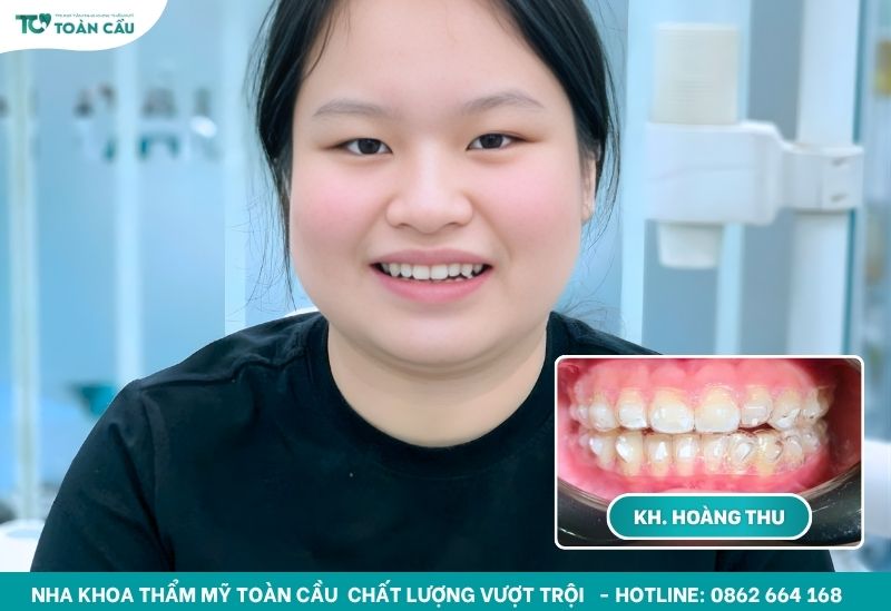 Giải đáp mất răng lâu năm có niềng được không 7 Khách hàng niềng răng trong suốt