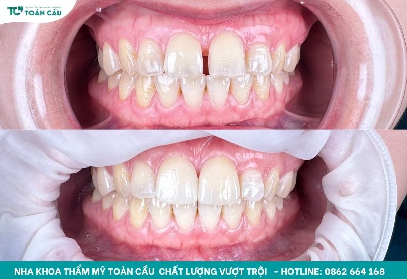 Khách hàng dán sứ răng cửa tại Toàn Cầu