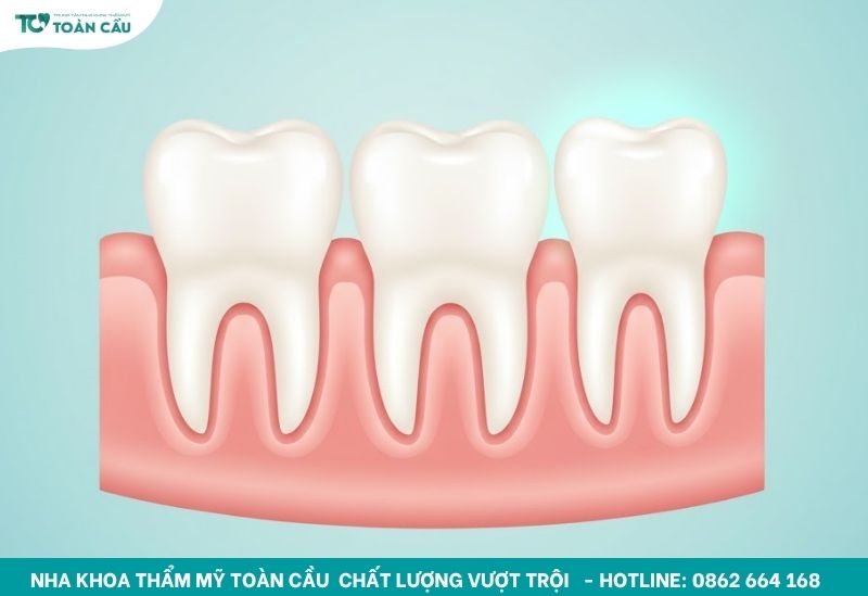 Răng khôn mọc thẳng, không đau