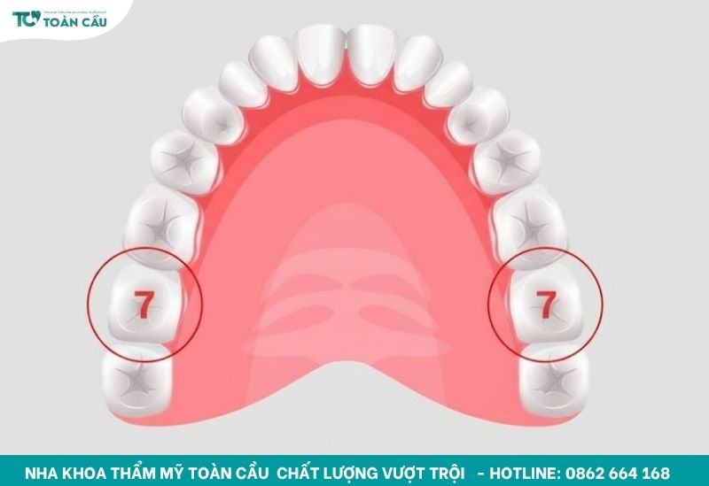 Răng hàm lớn số 7