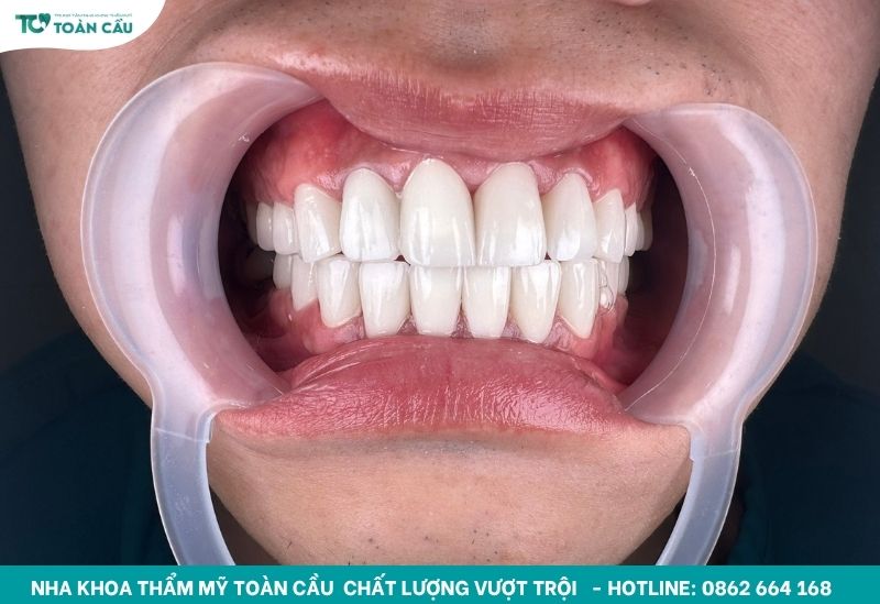 Răng thẩm mỹ và có chức năng hàm