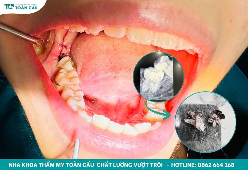 Nhổ răng khôn mọc lệch